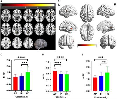 Abnormal regional spontaneous neural activity and functional connectivity in thyroid-associated ophthalmopathy patients with different activity: a resting-state fMRI study